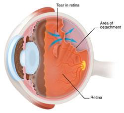Medical drawing depicting a tear in the retina with detachment